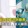 孕婦懷胎8月被迫剖腹產，醫生劃開肚皮後，家人嚇得渾身發抖