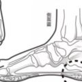 早上起床足跟痛到不能走路，活動一下，又慢慢不太疼了，為什麼？