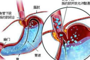 反流性食管炎的臨床症狀表現及最佳用藥治療方法！