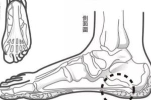 早上起床足跟痛到不能走路，活動一下，又慢慢不太疼了，為什麼？