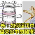 中醫骨傷：如何運用中醫治療，腰椎間盤突出中的腿疼和腿麻