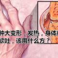 關節腫大變形，發熱，身體瘦弱，頭眩欲吐，該用什麼方？