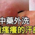 飽受瘙癢的「汗皰疹」痛苦的朋友，不妨試試！