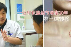 一位甲狀腺結節觀察10年，最後觀察成了淋巴結轉移，誰之過？