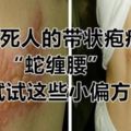 痛死人的帶狀皰疹「蛇纏腰」，試試這些小偏方！