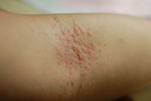 她發現9個月大的女兒「手腳突然出現紅疹」送醫檢查，結果醫生一看馬上就轉進加護病房緊急治療！