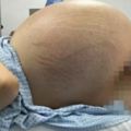 新婚人妻頂著巨大肚子身懷32公斤「怪胎」，手術取出的東西嚇壞了所有醫生！！
