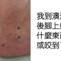 游泳上岸後發現「腳上有6個洞」　男子急PO網詢問　網友回：趕快砍掉它