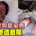 男子被狗舔染病四肢慘遭截除