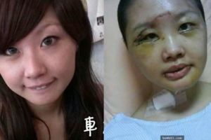 嘉義這妹子酒駕自撞「臉腫成豬頭」男友嫌醜跟人跑了，恢復後發表這勸世文…連小三看了都忍不住按讚！