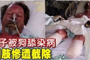 男子被狗舔染病四肢慘遭截除