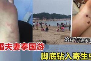 沙灘赤腳要當心！新婚夫妻泰國游，腳底遭寄生蟲鑽入，治療方法很恐怖~