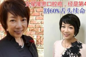 女星割60%舌頭續命！「口腔癌4期」　舌破只擦口內膏...就醫才知