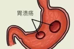 胃潰瘍是怎麼形成的？5大常見早期癥狀你應了解！