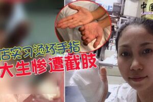 酒店實習燙壞手指22歲女大生被逼截斷4根手指!