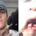 24歲帥牙醫「自己的智齒自己拔」，「打麻醉+拔牙齒+縫傷口」分享全過程爆紅網路！