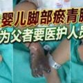 初生嬰兒腳部瘀青腫脹為父者要醫護人員負責