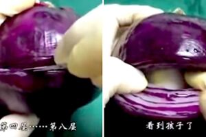 用洋蔥來「模擬剖腹產」因為太過真實在網路瘋傳！無數網友看完痛到落淚：媽媽太偉大了！