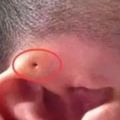 注意！你家寶寶耳朵上有這種小孔嗎？如果有，就要小心了！