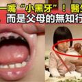 4歲女童一嘴小黑牙，兒科醫生：不是因為糖，而是家長的這種行為