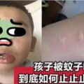 寶寶被蚊子咬了塗花露水、風油精？兒科醫生：錯！試試這幾招