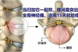 當歸加它一起熬，腰間盤突出，坐骨神經痛，連喝15天就能痊癒！