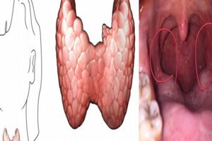 剛患上甲狀腺癌時，會有4個最好認的前兆，不容忽視！