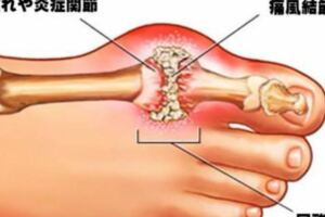 高尿酸、痛風的人註定與吃魚無緣？錯！這3種食物才真不該吃