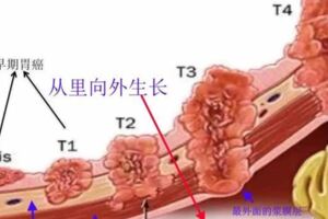 胃癌為何偏愛年輕人？這4點是主因，你中招了麼？