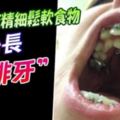 給小童吃精細鬆軟食物當心長「雙排牙」