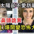 愛曬太陽卻不愛防曬,美女鼻頭詭異「痘痘」爆開變恐怖大洞