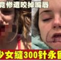 拒復合竟慘遭咬掉嘴唇少女縫300針永留丑疤!