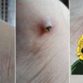 他腳痛了一個月，沒想到竟擠出綠色物體？網友大驚：果然高手在民間！