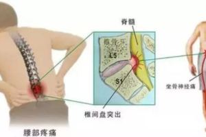 「最傷腰的6個姿勢」，你肯定天天在做！「3個簡單動作」拯救你的腰！