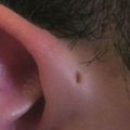 一直都不知道為什麼有人耳朵上會有「這個小洞」，看了醫學的解釋大家都不得不注意了！