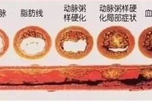 血管外科專家推薦：一個方子將血管壁清理的乾乾淨淨！千金難求