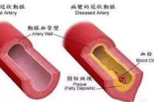 冬天如何保護血管多吃天然血管阿司匹林