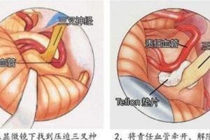 「牙疼不算病」真疼起來要人命，三叉神經作怪名醫妙手祛除老牙痛