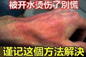 被開水燙傷了別慌，謹記這個方法解決快來看看