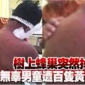 樹上蜂巢突然掉下無辜男童遭百隻黃蜂蟄傷