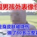 奇聞|美國男孩外表像怪物，4歲時全身皮膚被燒傷，做了80多次整容手術！