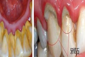 總是洗牙也不管用，牙結石還是那麼臭？教你三個小方輕松去除！