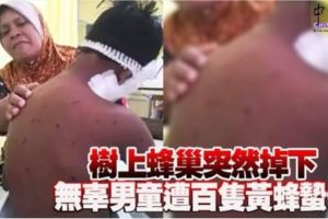 樹上蜂巢突然掉下無辜男童遭百隻黃蜂蟄傷