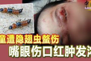 2童遭隱翅蟲螫傷嘴眼傷口紅腫發濃
