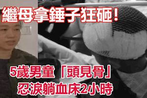 繼母拿鎚子狂砸！5歲男童「頭見骨」忍淚躺血床2小時