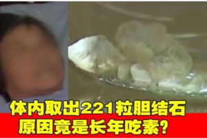 老婦體內取出221粒膽結石原因竟是長年吃素？