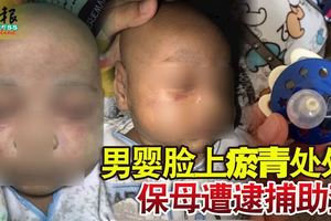 才被送往保母家兩天，兩個月大男嬰臉上瘀青處處，保母遭逮捕助查！
