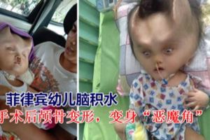 菲律賓幼兒腦積水手術後顱骨變形，變身「惡魔角」