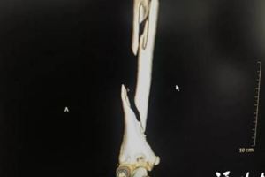 屁孩想紅拍抖音手伸洗衣機當場遭絞斷慘成「三節棍」！