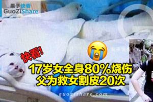 超感人！17歲女全身80%燒傷，父為救女割皮20次！網民感動淚流...